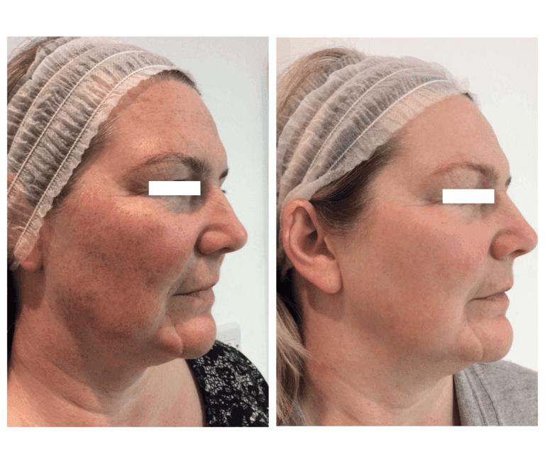 Marina-before-after-face-treatment