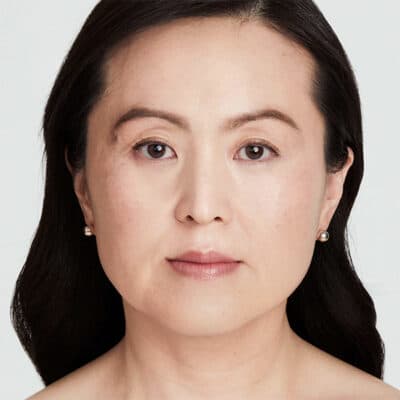 grace-180days-ultherapy