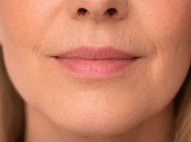 Lip-lines-close-up