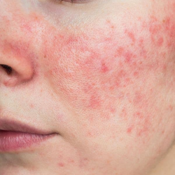 rosacea-close