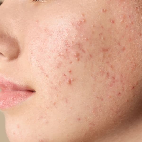 Acne-scarring-close