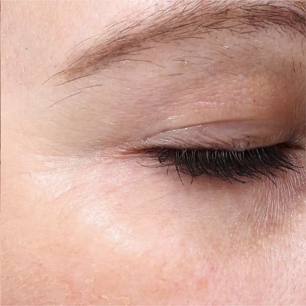 eye-lid-treatment-laser