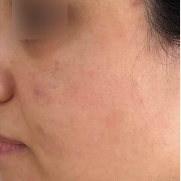 3DMIRACL-After-8-weeks