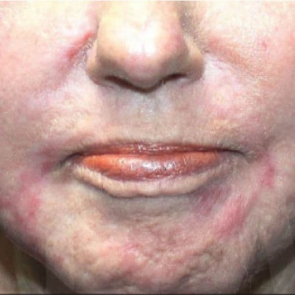 Scarring-after-ultraclear