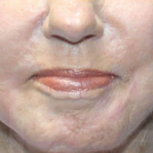 5-weeks-after-ultraclear