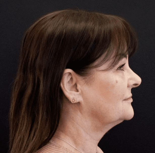 Endolift-after-face-profile