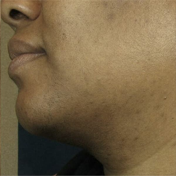 after-picosure-treatment