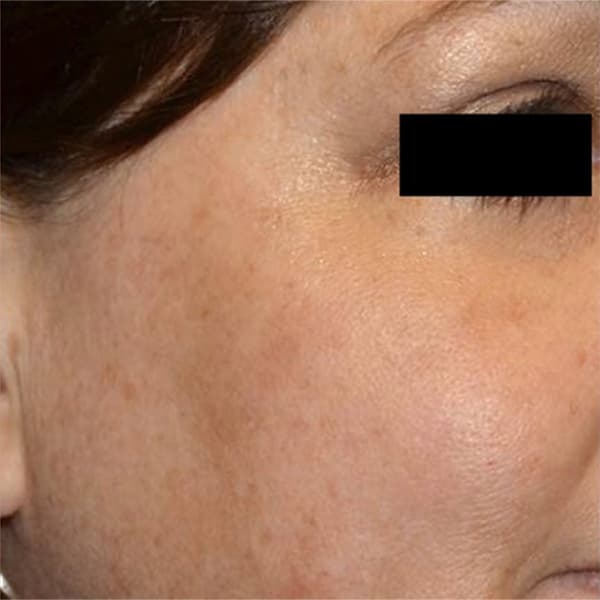 after-picosure-treatment